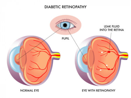 Diabetic Retinopathy - Normal Eye vs Retinopathy Eye
