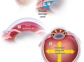glaucoma pix1